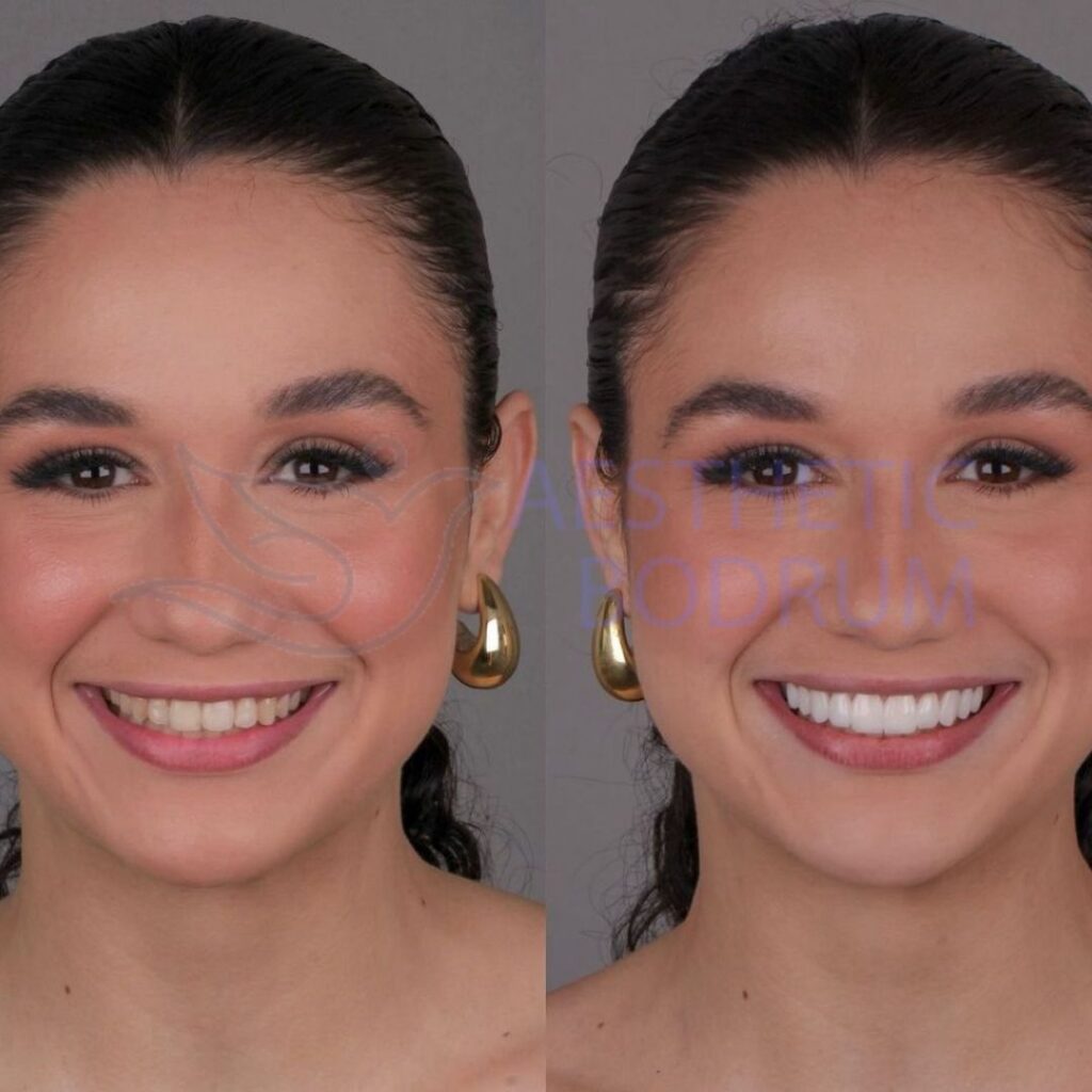 Zirconium Crown Bodrum Before After