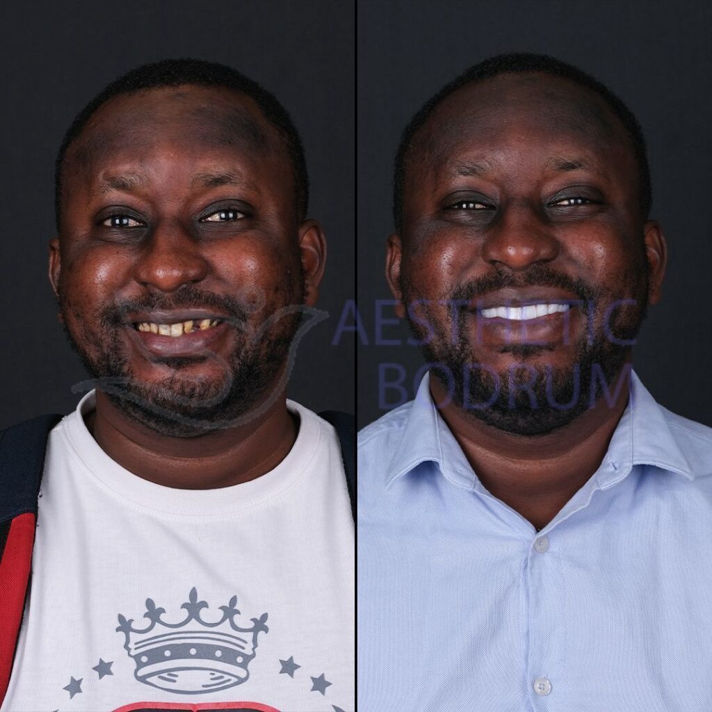 Empress Lamina Bodrum Before After