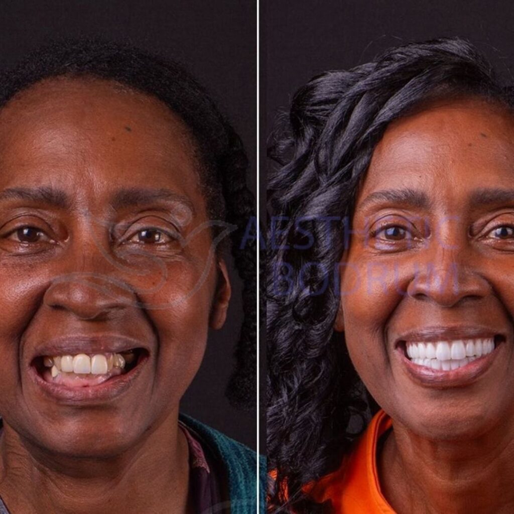 Empress Lamina Bodrum Before After