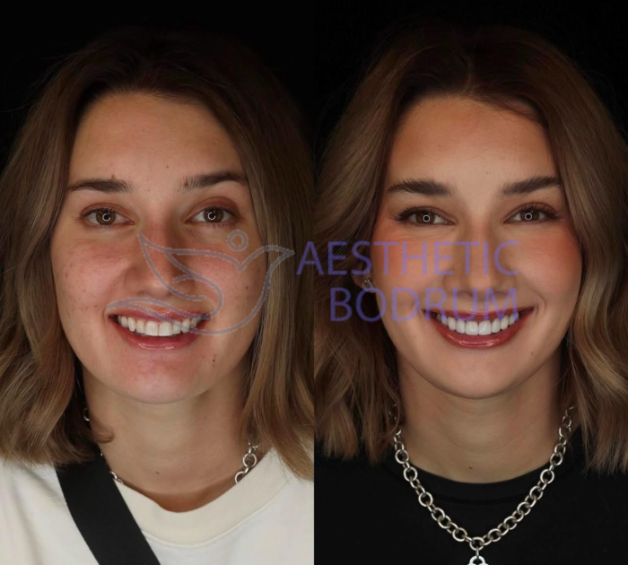 Teeth Whitening Techniques and Precautions