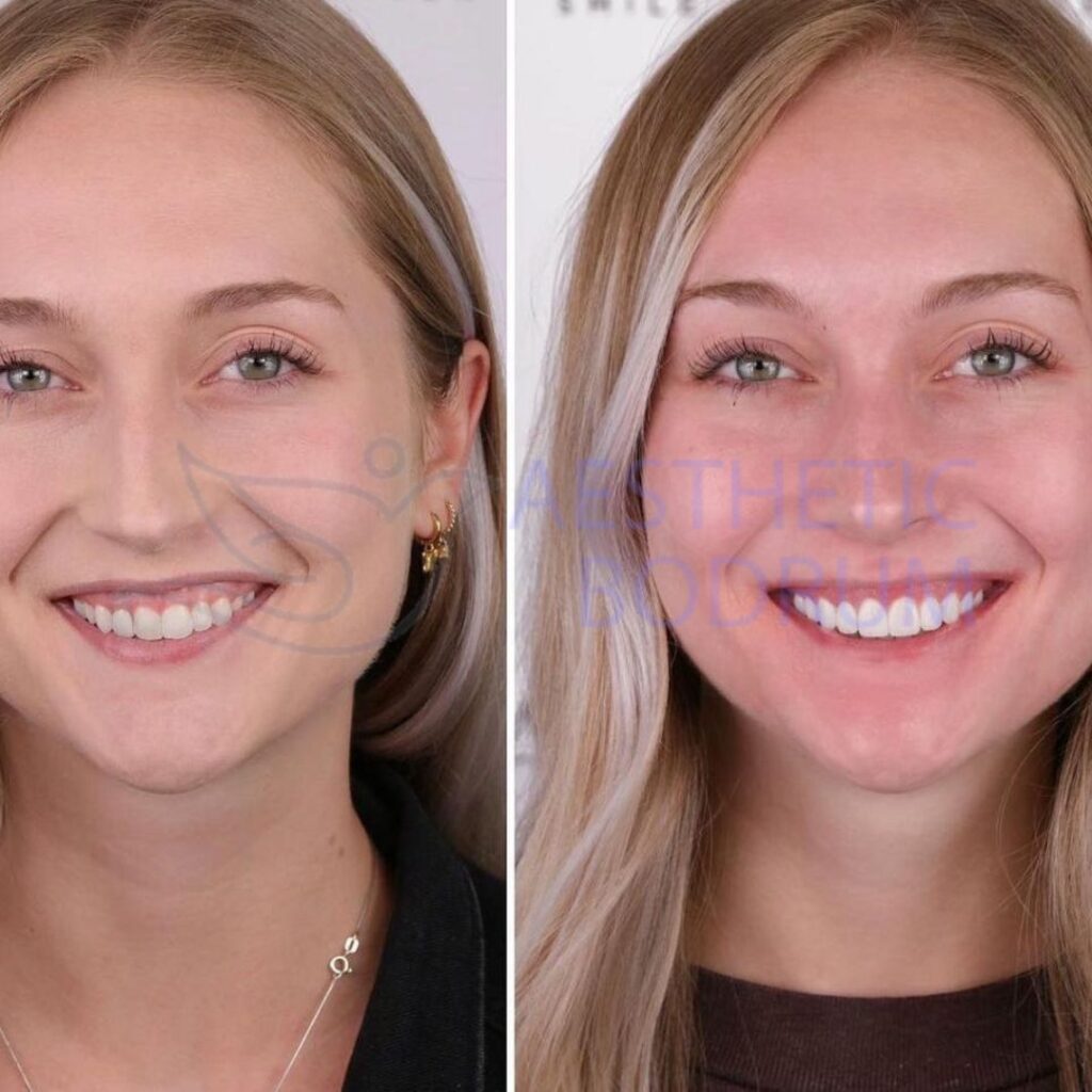 Dentist Gumbet Before After