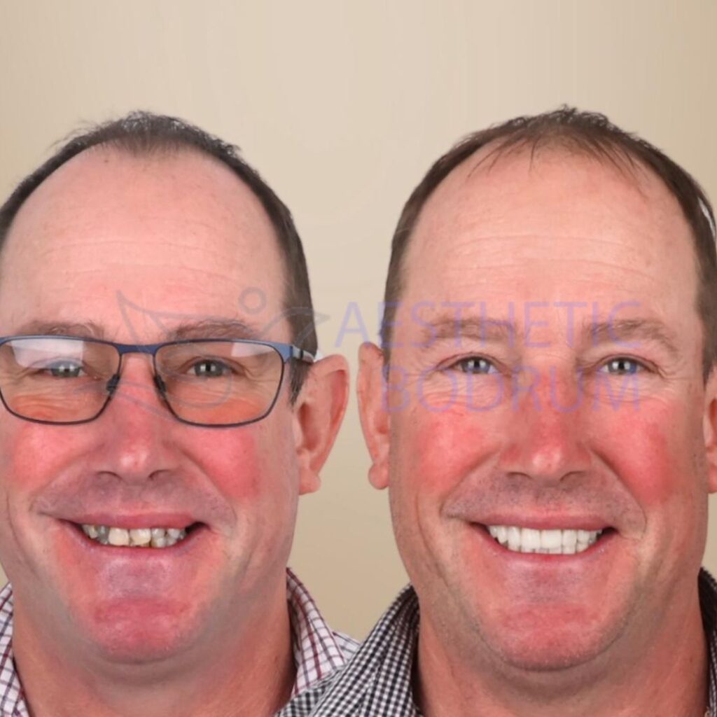 Teeth Whitening Bodrum