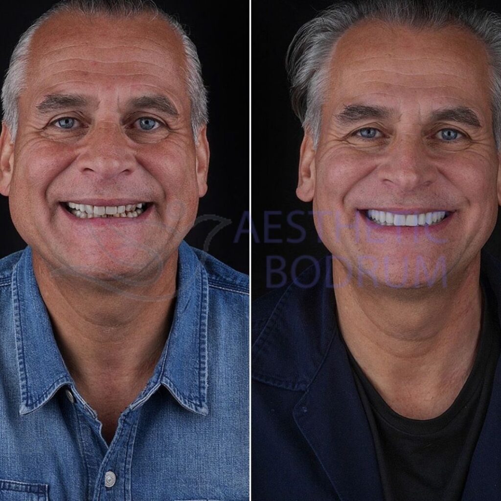 Emax Crown Bodrum Before After