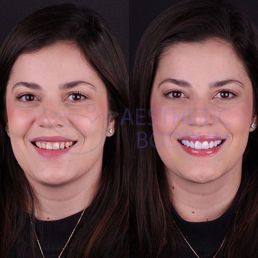 Emax Crown Bodrum Before After