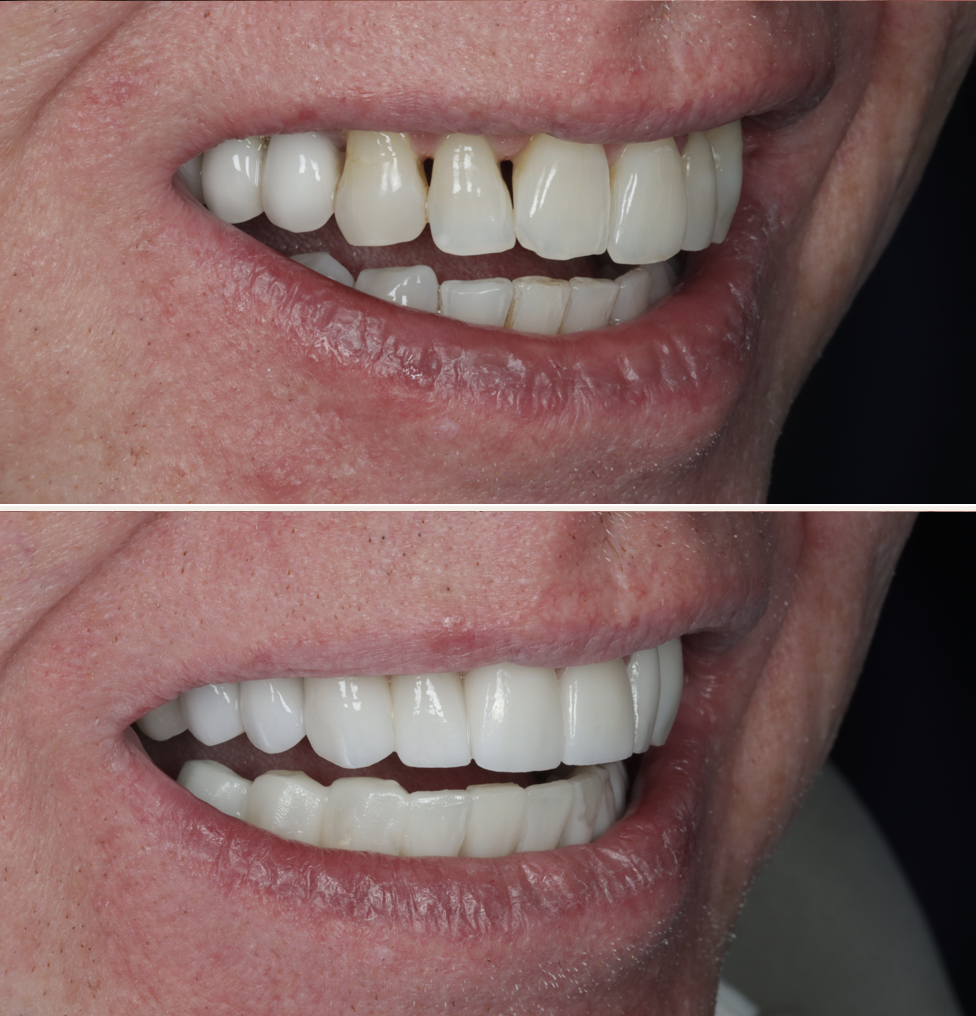 Composite Bonding Bodrum Before After 