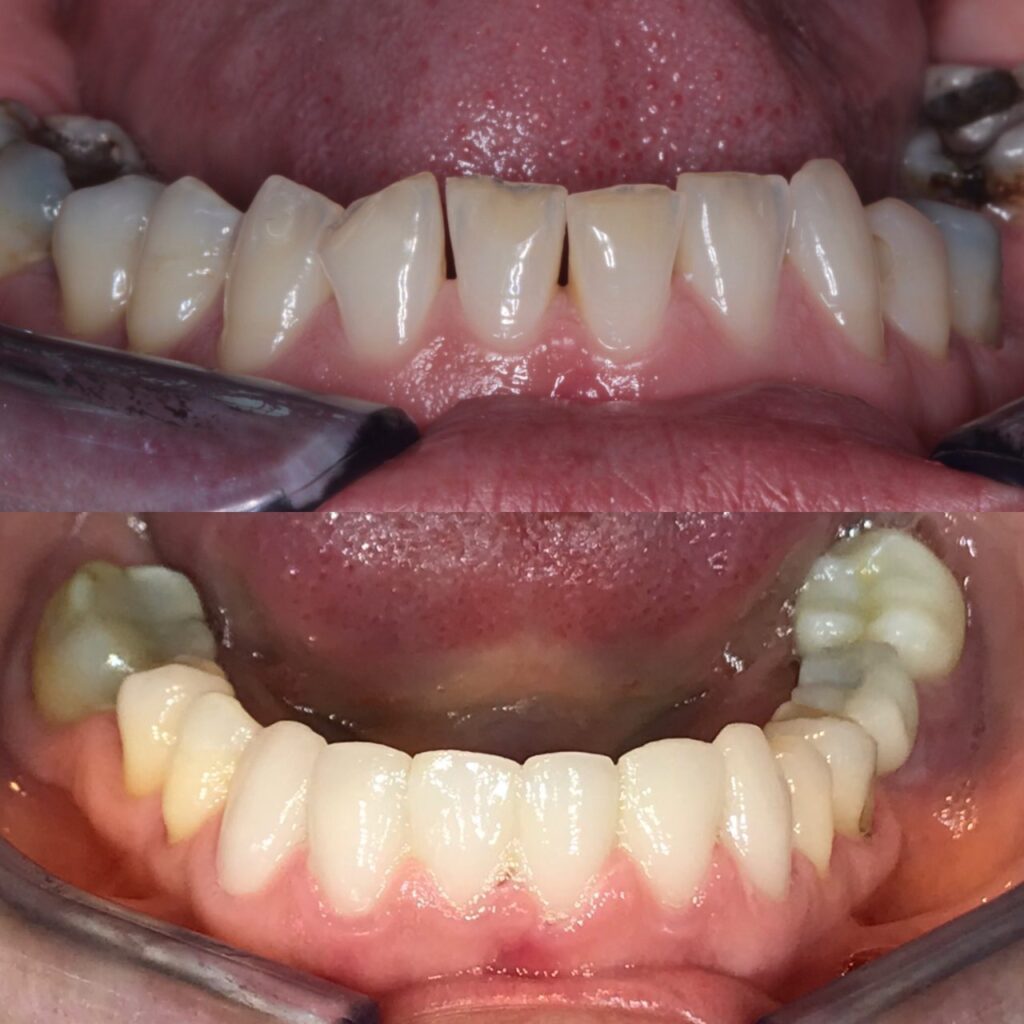 Composite Bonding Bodrum
