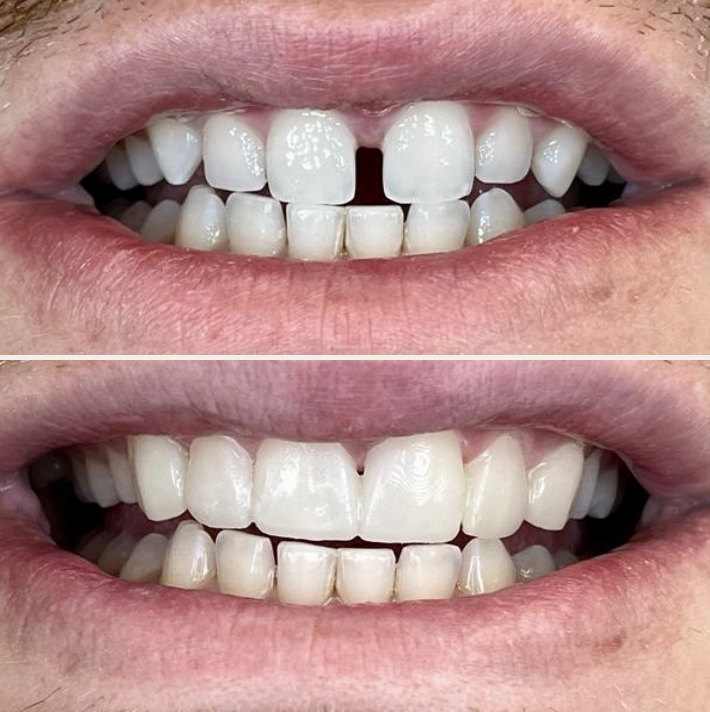 Composite Bonding Bodrum Before After 