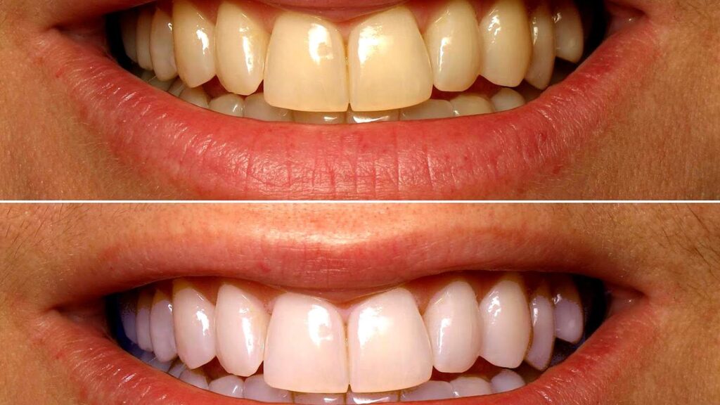 Teeth Bleaching Bodrum Before After