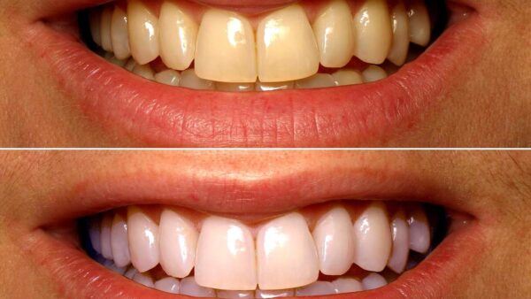 Teeth Whitening Techniques and Precautions