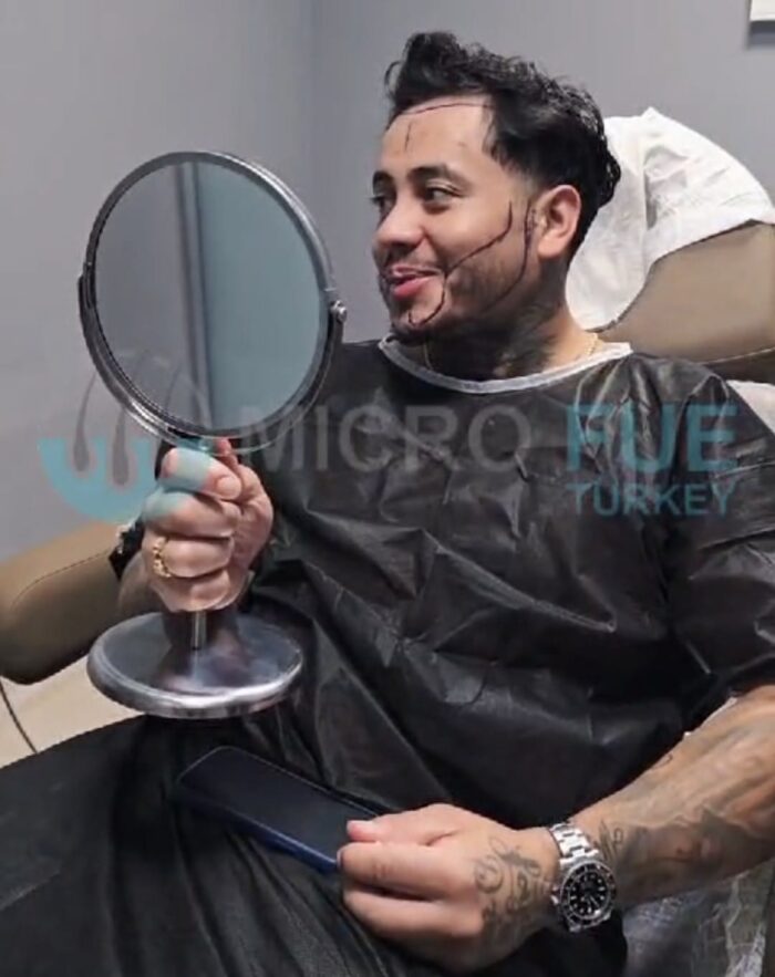 Beard Transplant Cost Turkey