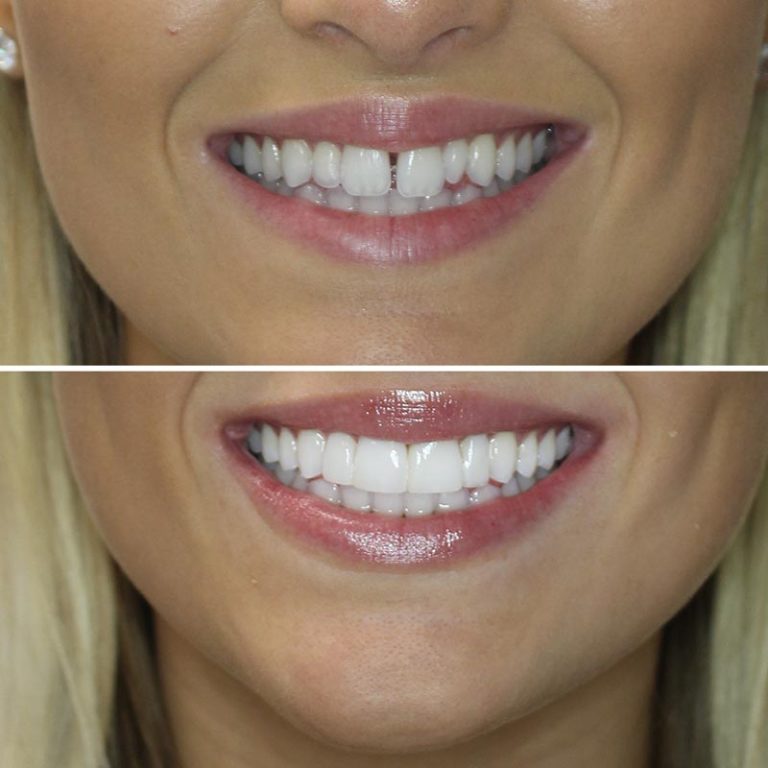 Composite Bonding Bodrum Before After 