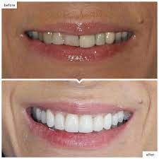 Porcelain Crown Bodrum Before After