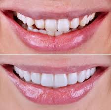 Zirconium Crown Bodrum