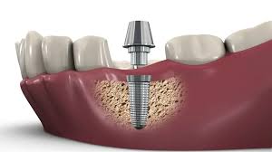 Dental Implants Process and Benefits