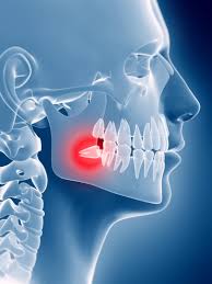Wisdom Tooth Extraction Bodrum