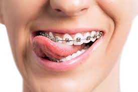 Bodrum Orthodontic Treatment