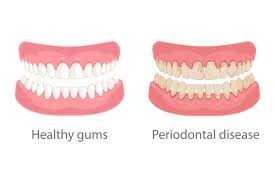What is Gum Recession