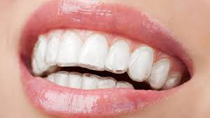 Clear Aligners Bodrum