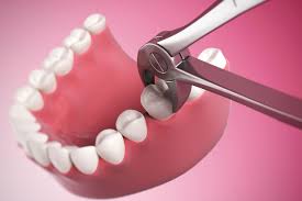 Tooth Extraction Bodrum