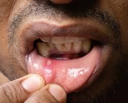 Mouth Ulcers and Treatment Methods