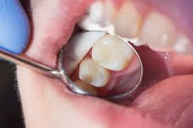Dental Fillings Bodrum