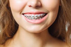 Braces in Bodrum