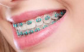 Bodrum Orthodontic Treatment