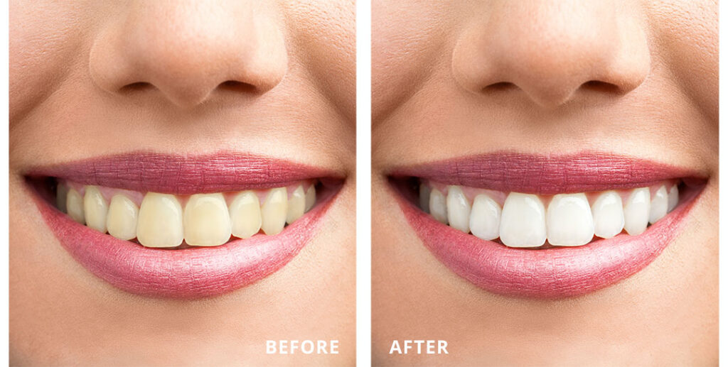Teeth Bleaching Bodrum