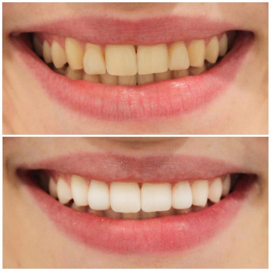 Teeth Bleaching Bodrum Before After
