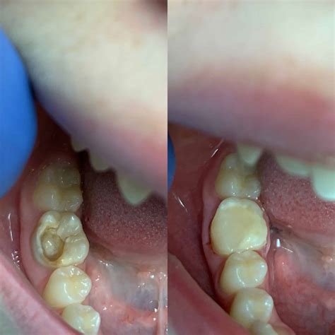 Root Canal Treatment Bodrum Before After