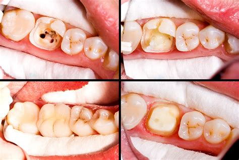 Root Canal Treatment Bodrum Before After