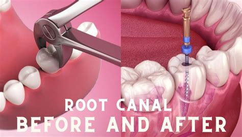 Root Canal Treatment Bodrum Before After