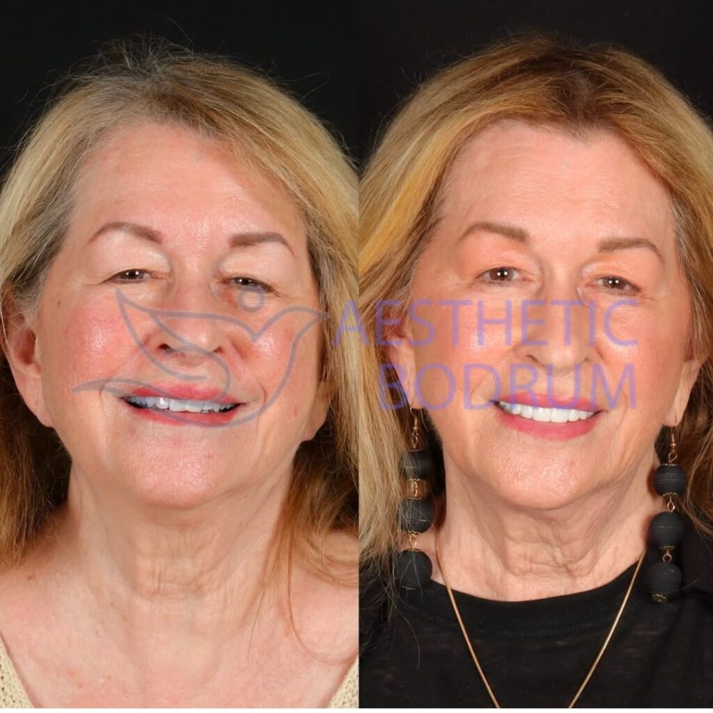 Dental Implant in Bodrum