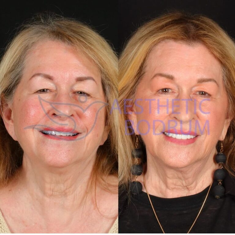 Combining a Holiday in Kos Island with Dental Treatment in Bodrum