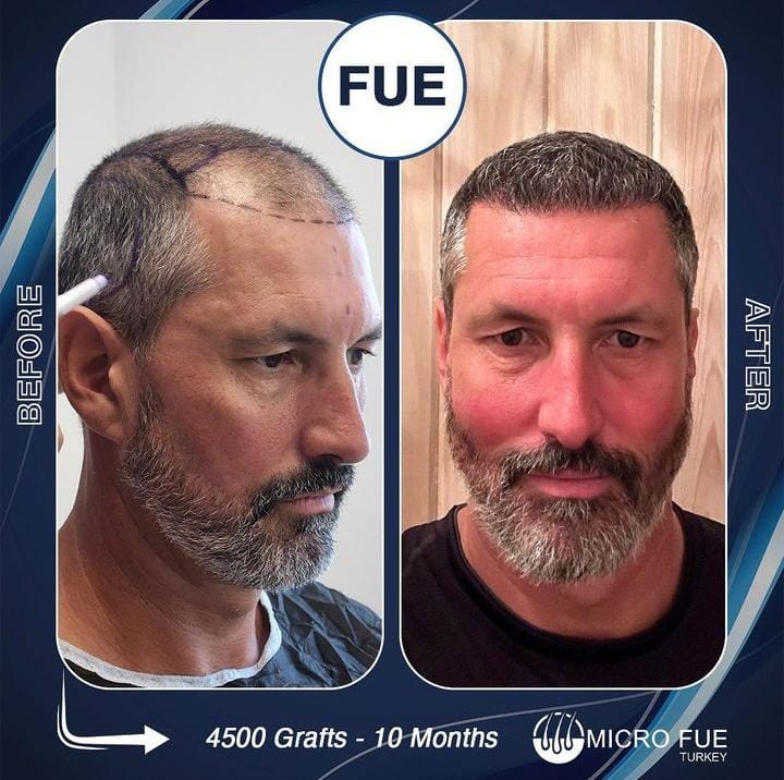 Affordable Hair Transplant in Bodrum