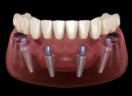 All-on-4 Dental Implants in Bodrum