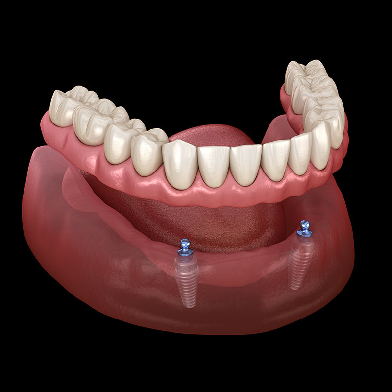 Removable Dentures in Bodrum