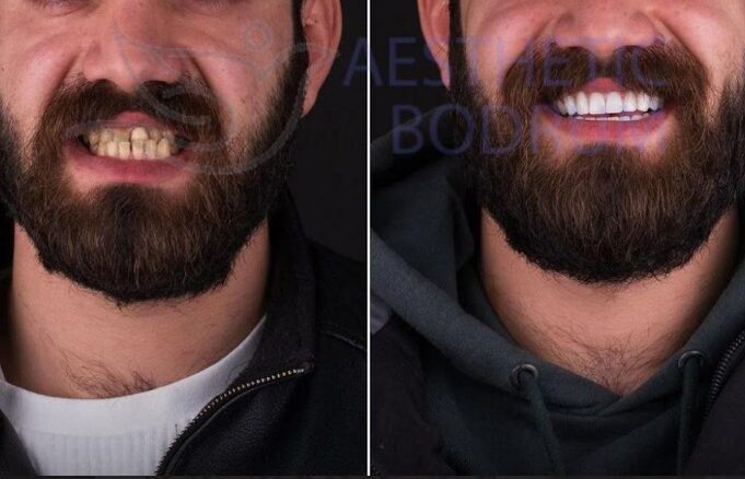 How to Go to Dentist Gumbet