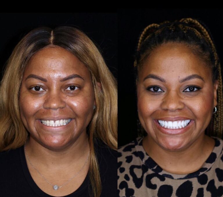 24 Zirconium Crown in Bodrum Before After