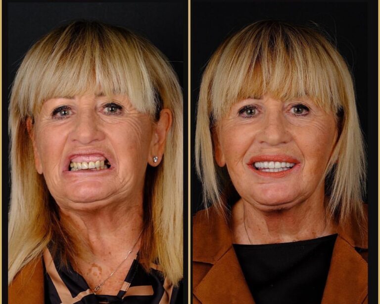 8 Implants and 24 Zirconium Crowns