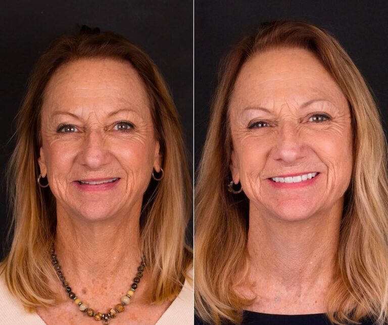 20 Emax Veneers for a 58-Year-Old Patient from Switzerland