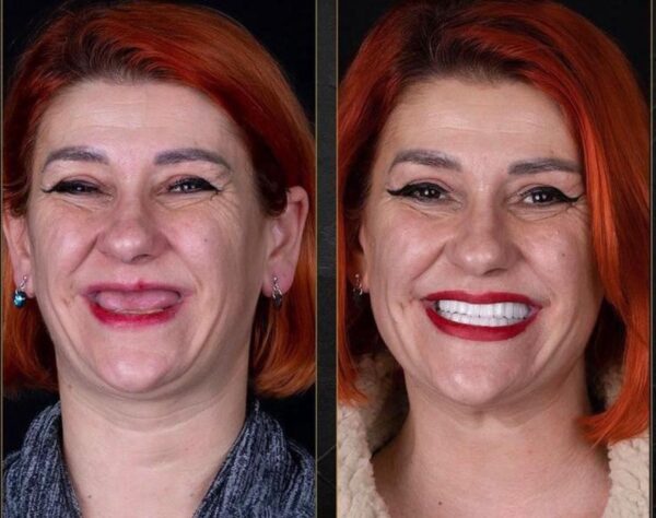 Can Diabetics Get Dental Implants?