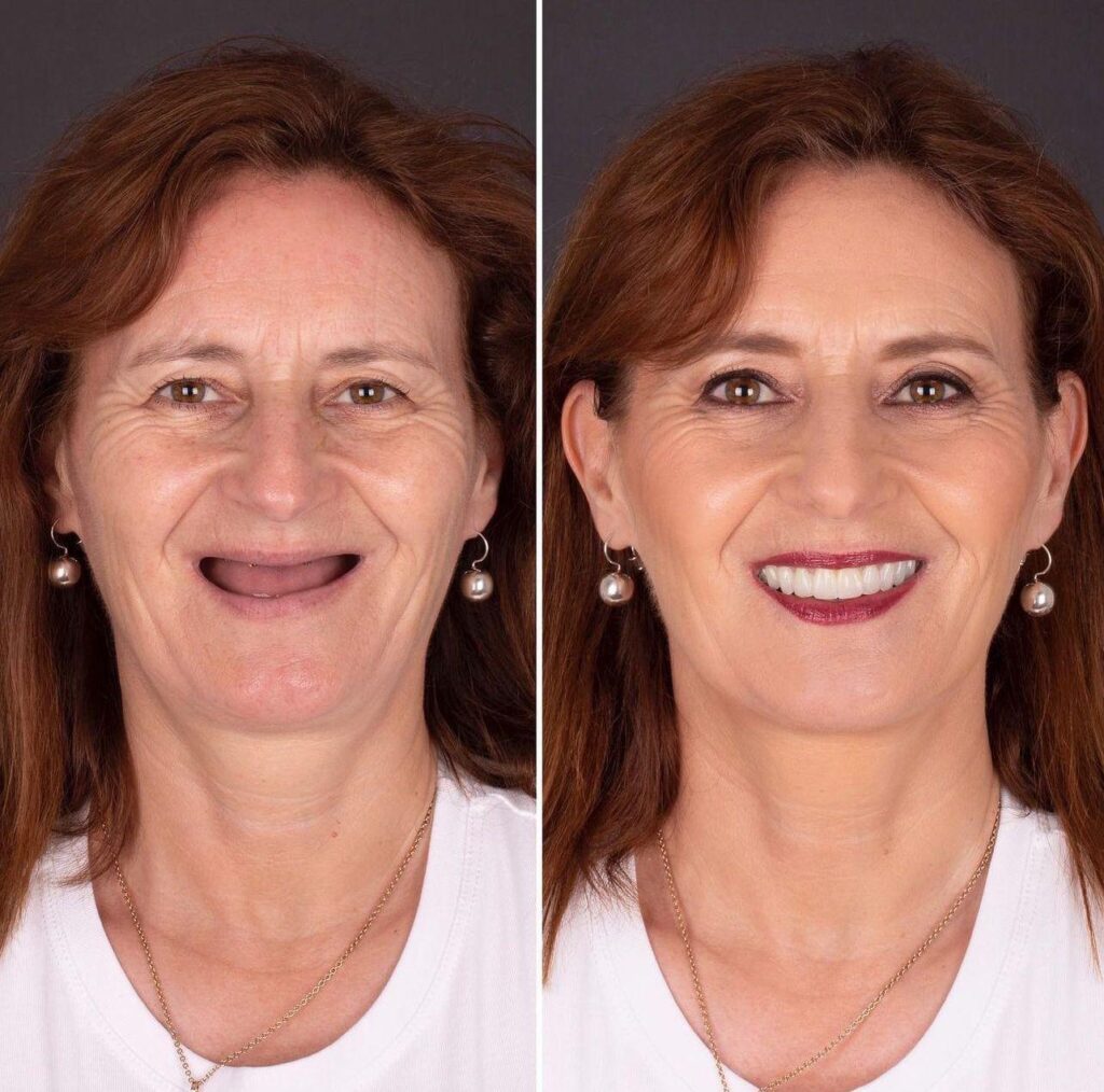 12 Implants & 24 Monolithic Zirconium Crowns