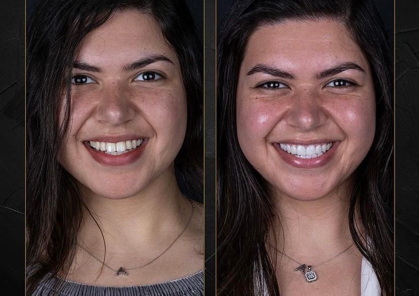 Complete Smile Makeover with 20 Laminate Veneers at a Leading Dental Clinic in Gümbet, Bodrum