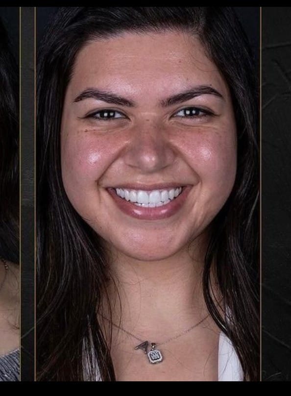Complete Smile Makeover with 20 Laminate Veneers at a Leading Dental Clinic in Gümbet, Bodrum
