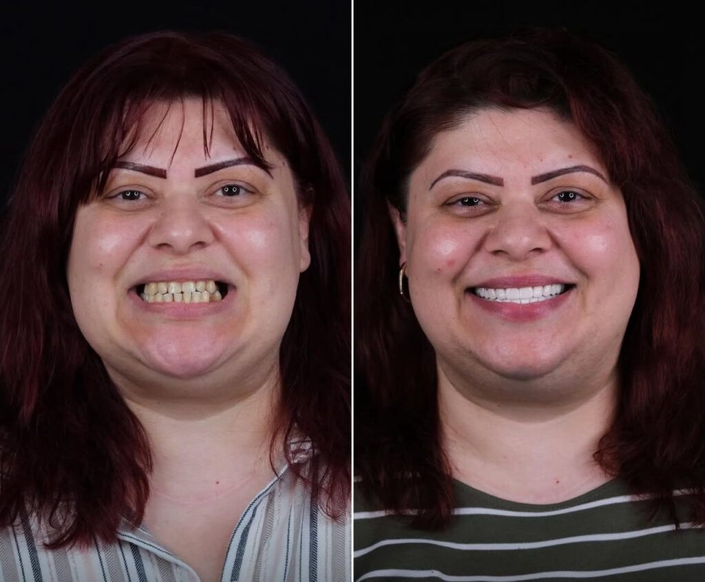 5 Implant 24 Zirconium Crown 🇧🇬 Bulgaria Patient 42 Age Dentist in Bodrum