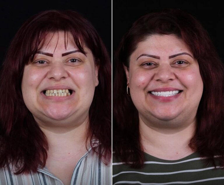 5 Implant 24 Zirconium Crown 🇧🇬 Bulgaria Patient 42 Age Dentist in Bodrum