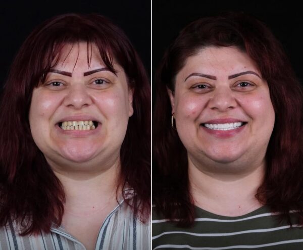 5 Implant 24 Zirconium Crown 🇧🇬 Bulgaria Patient 42 Age Dentist in Bodrum