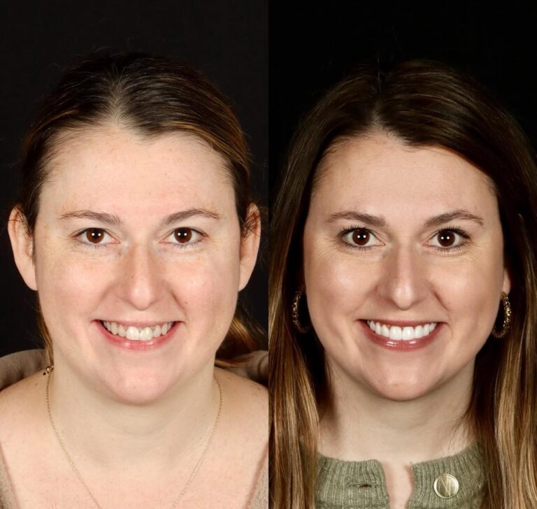 4 Implants + 16 Emax Veneers + 4 Monolithic Zirconium Crowns in Bodrum