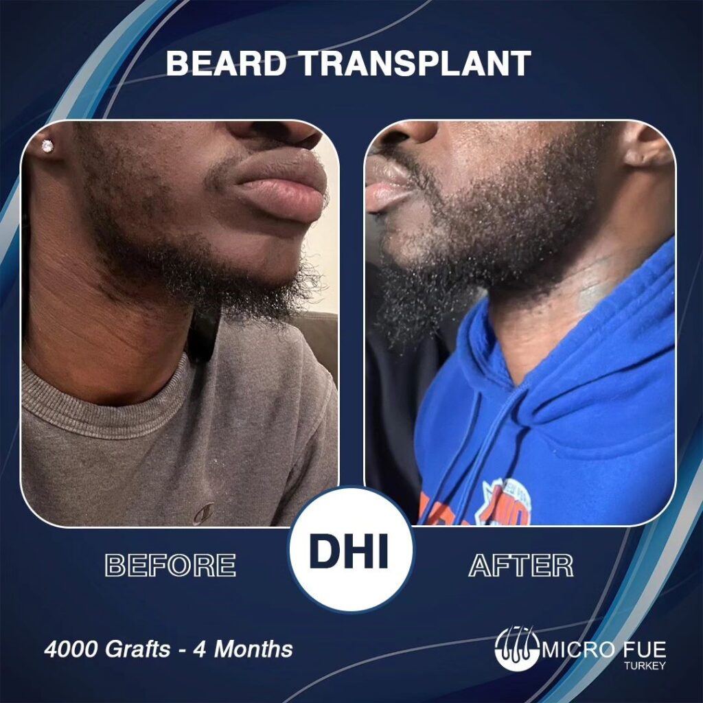 Beard Transplant Cost Turkey